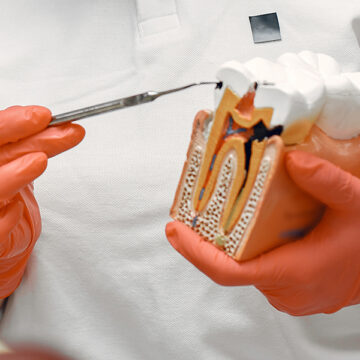 Root Canal Treatment