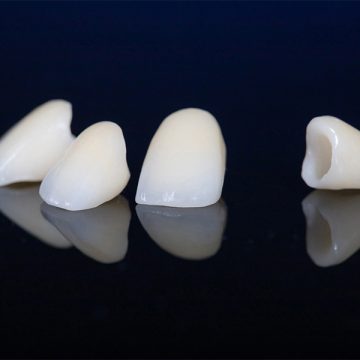 Can Dental Crowns Protect Weak Teeth From Further Damage?